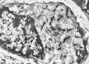 M,2m. | hypotonic syndrome - muscular atrophy